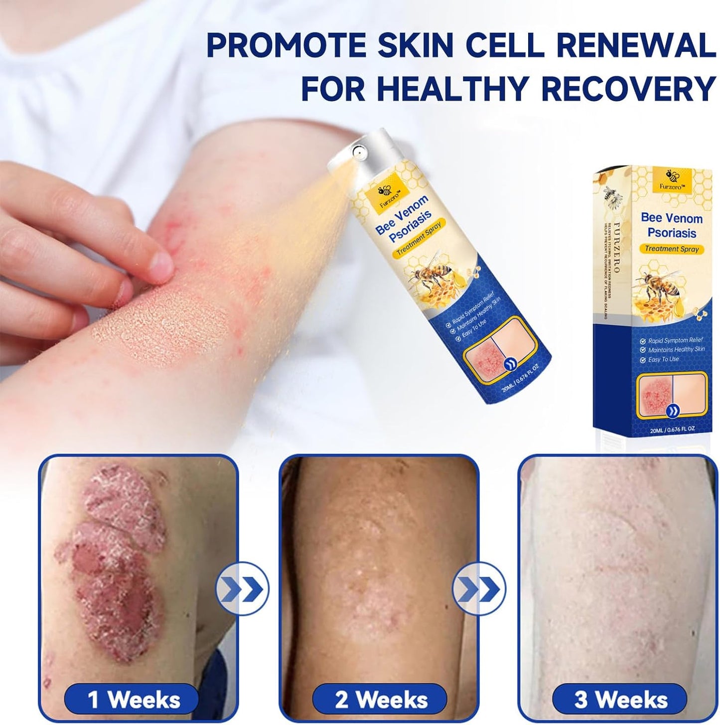 DermaEase™ | Øjeblikkelig lindring af genstridig psoriasis