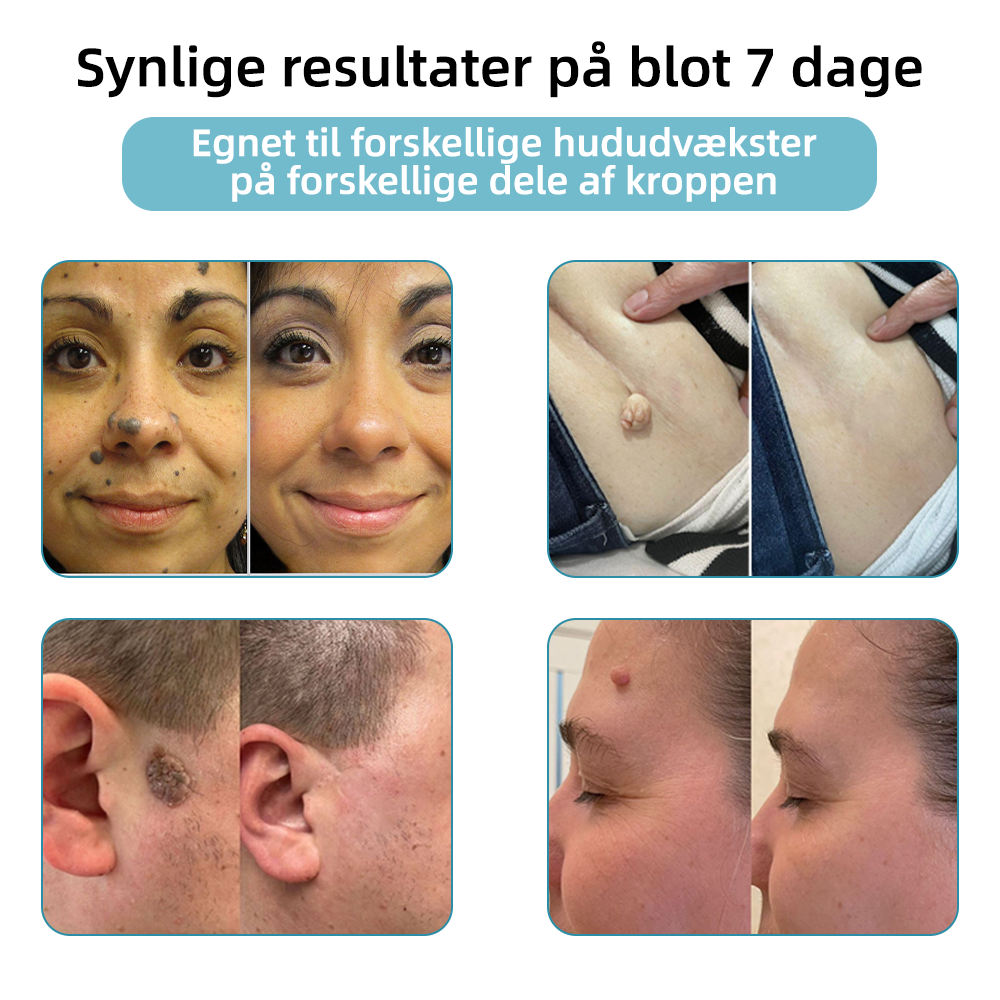 Pletvæk™ | Klar hud på en enkel måde - ingen nåle, ingen smerte!