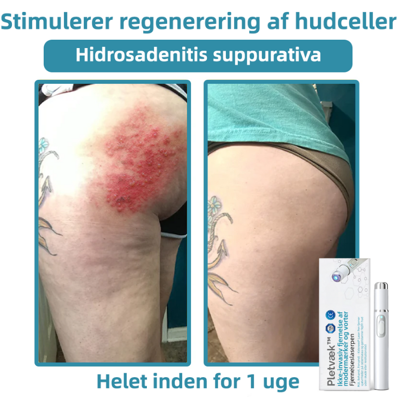 Pletvæk™ | Klar hud på en enkel måde - ingen nåle, ingen smerte!