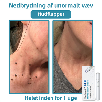 Pletvæk™ | Klar hud på en enkel måde - ingen nåle, ingen smerte!