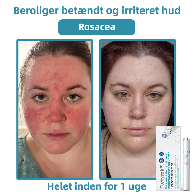 Pletvæk™ | Klar hud på en enkel måde - ingen nåle, ingen smerte!