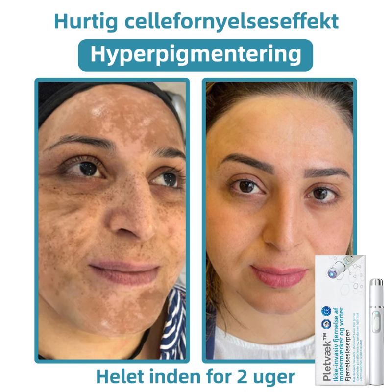 Pletvæk™ | Klar hud på en enkel måde - ingen nåle, ingen smerte!