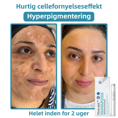 Pletvæk™ | Klar hud på en enkel måde - ingen nåle, ingen smerte!